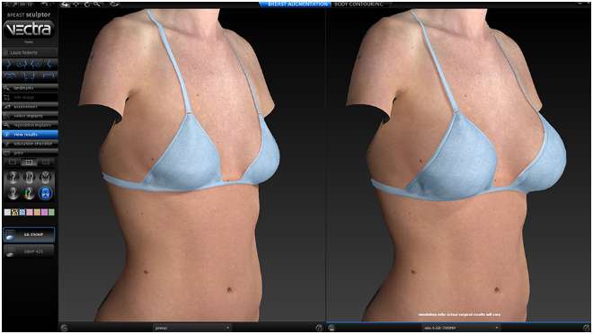 Why Breast Reduction in Louisville, KY