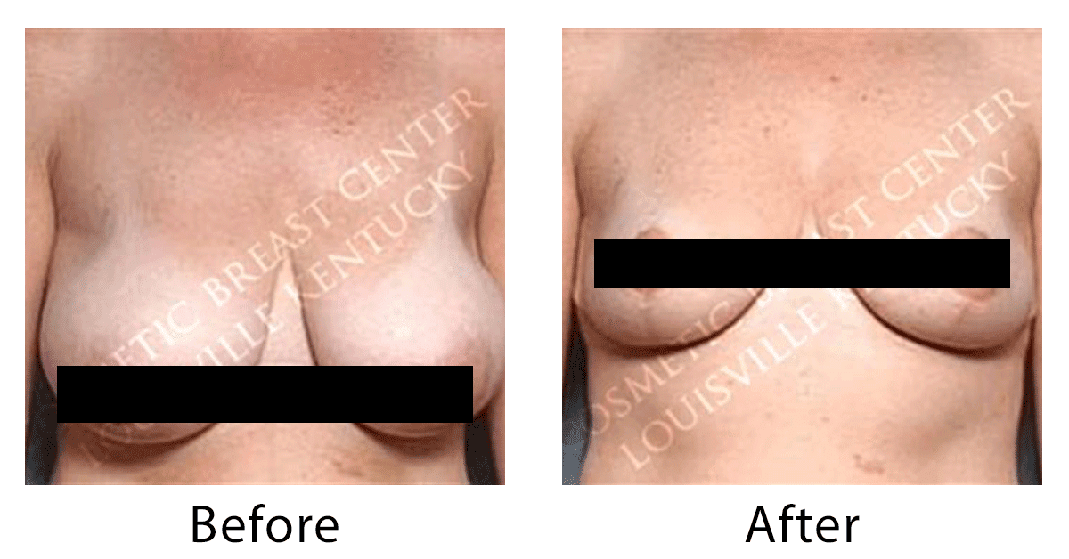 The Top 5 Reasons to Consider a Breast Lift or Breast Reshaping