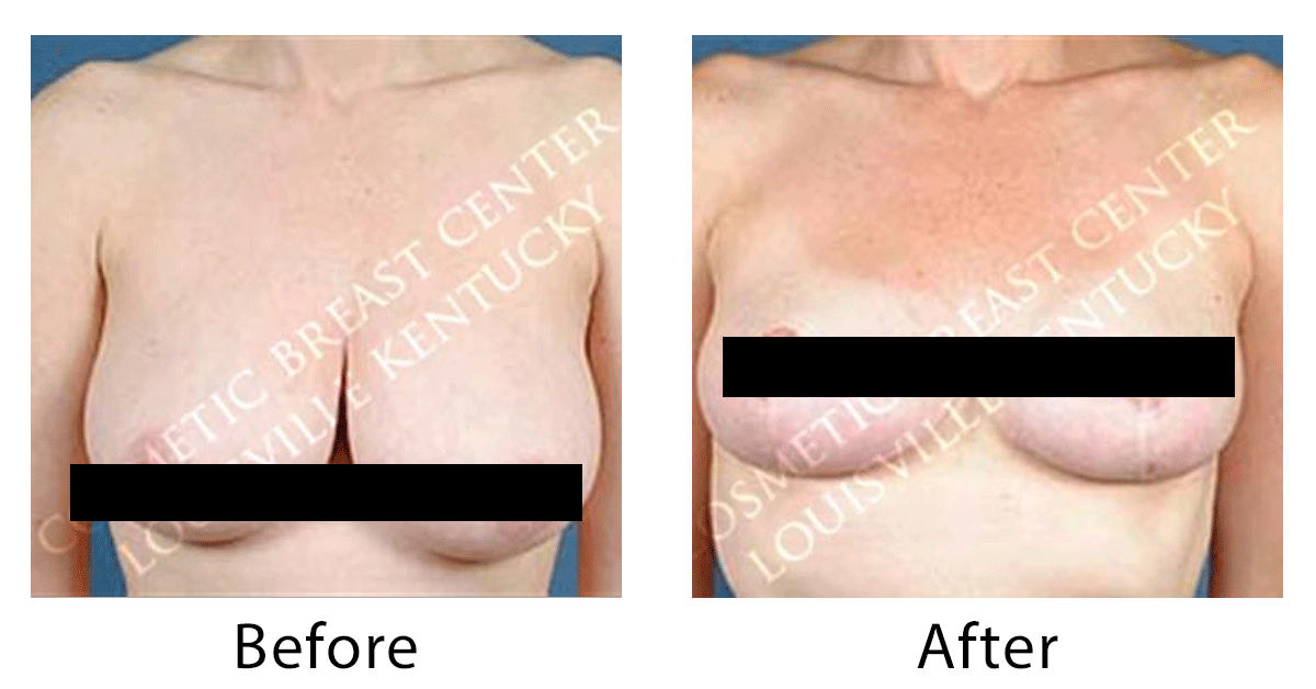 Big breasts vs. small breasts, what is the difference between